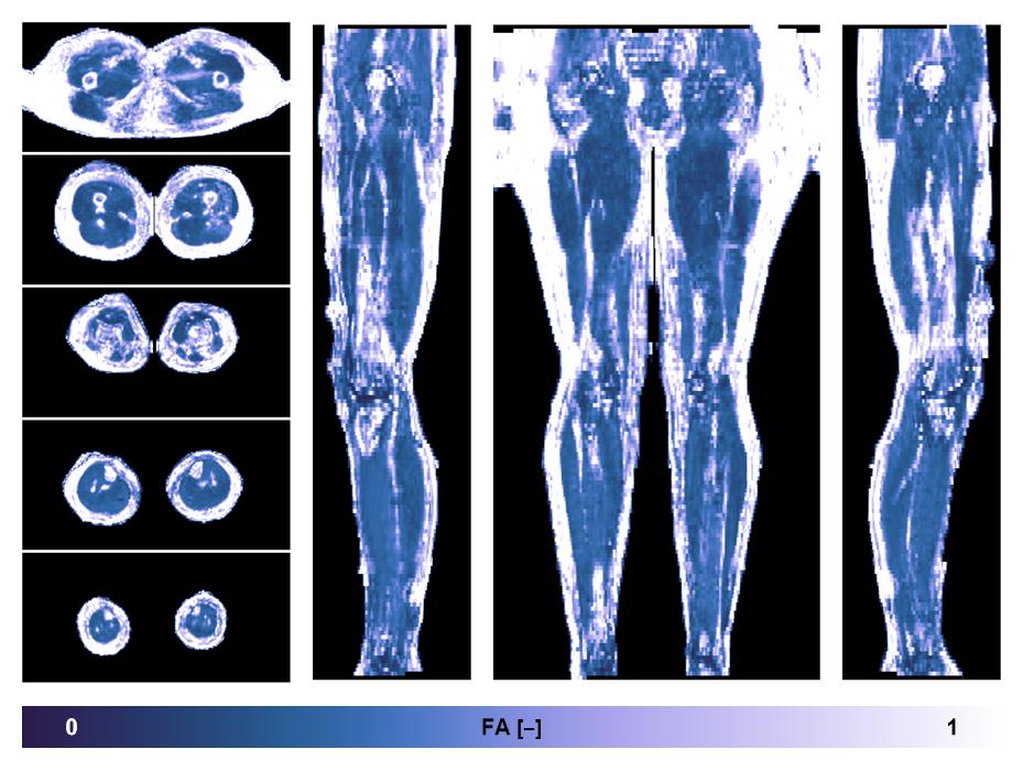 IVIM corrected whole leg muscle fractional anisotropy obtained from diffusion tensor imaging.